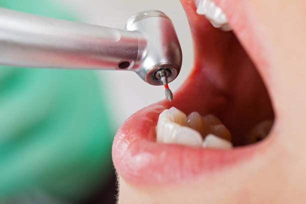 Best Emergency Dental Care for Broken or Chipped Teeth in Weston, FL